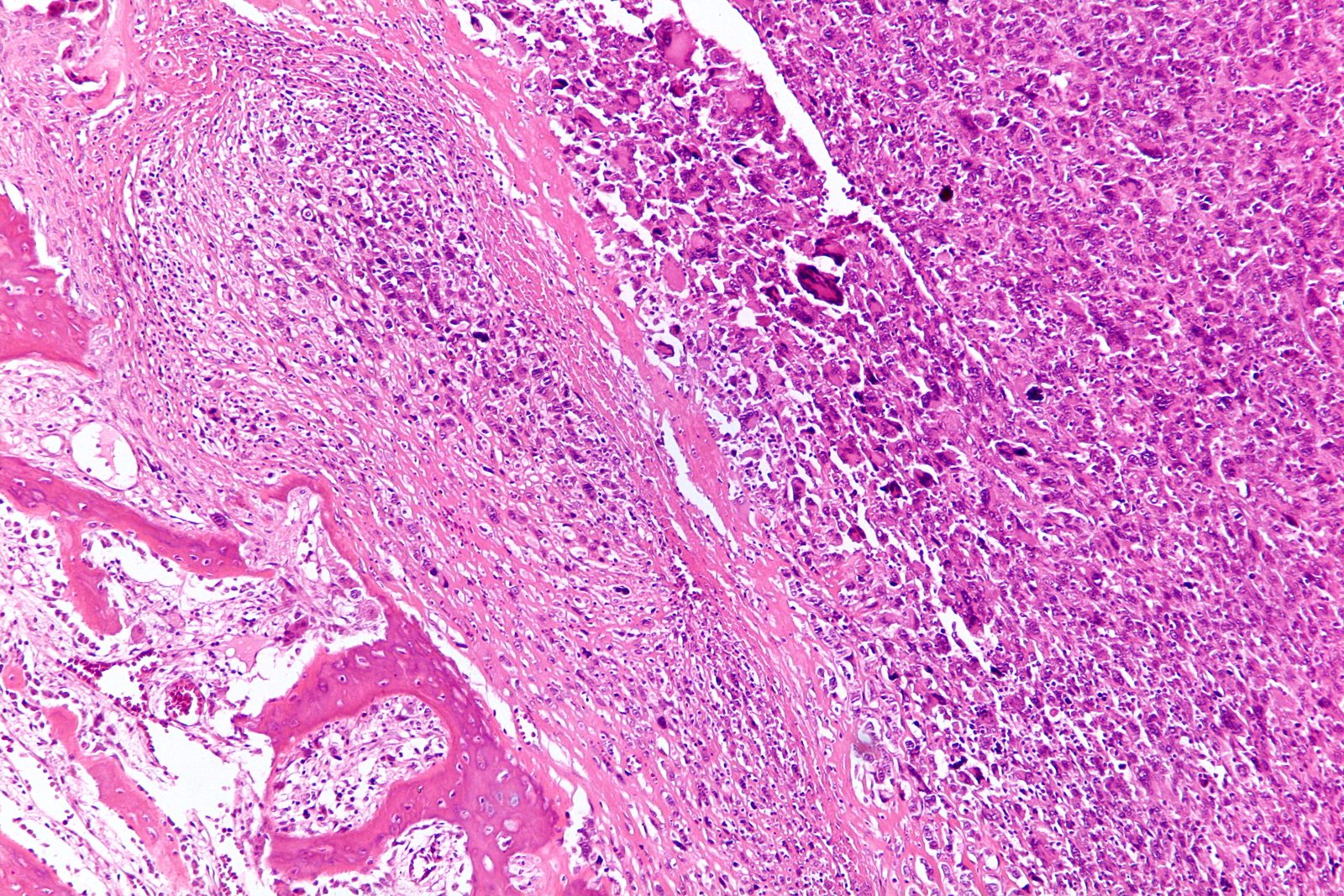 A labelled plain radiograph of an aggressive primary bone lesion showing the zone of transition, cortical destruction, aggressive periosteal reaction and soft-tissue extension, with a warning that imaging suggests urgency but does not replace specialist biopsy.