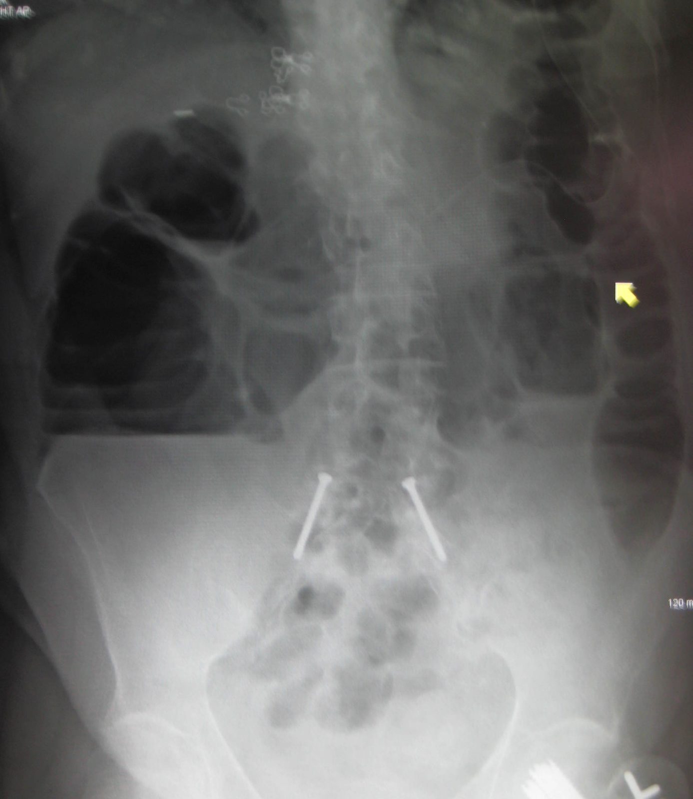 Erect abdominal radiograph showing dilated bowel loops in intestinal obstruction; use it for pattern recognition but emphasise that prompt contrast CT is the preferred definitive test when appropriate.