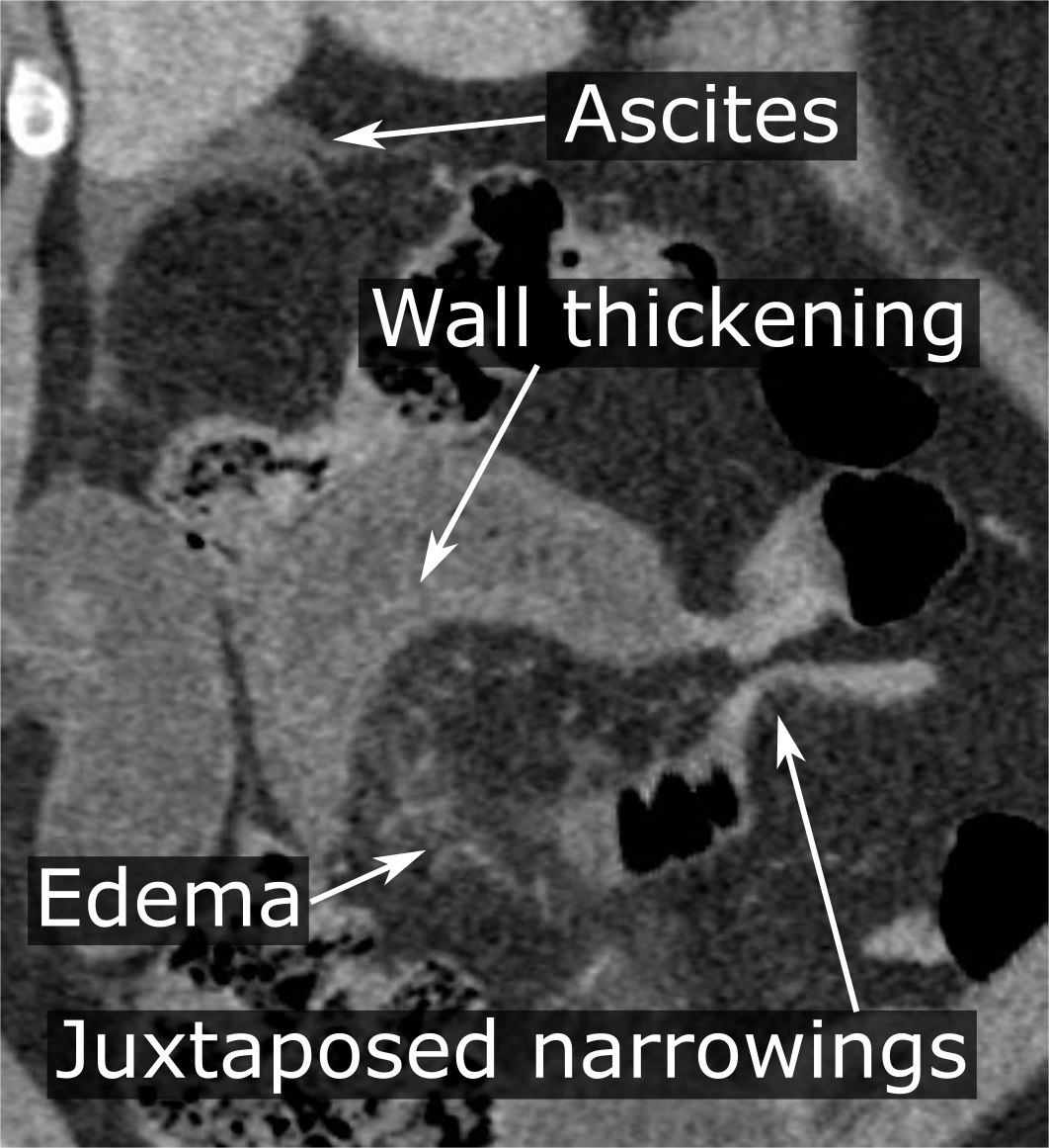 Axial CT image demonstrating a closed loop of strangulated bowel with reduced wall enhancement and mesenteric oedema; image recognition must be linked to urgent senior surgical review.
