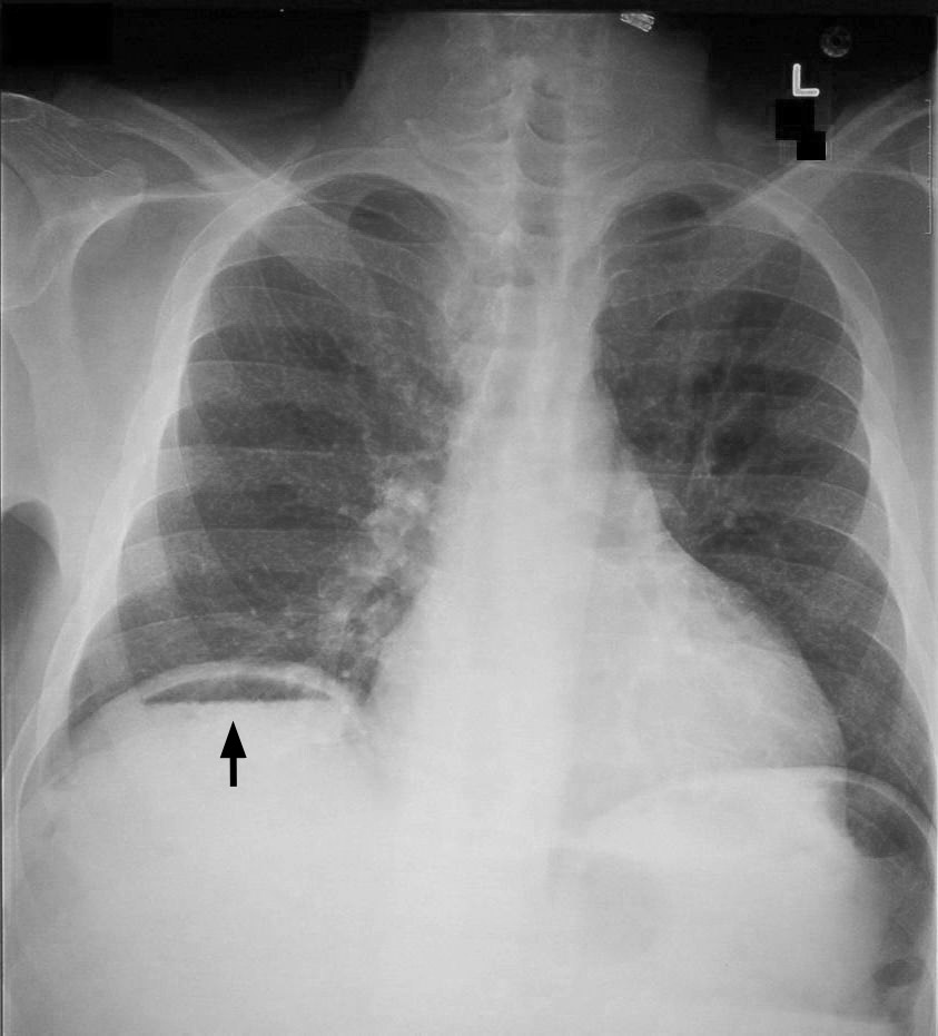 An erect chest radiograph showing a crescent of free gas beneath the right hemidiaphragm, illustrating pneumoperitoneum from a perforated viscus while noting that a negative film does not exclude perforation.