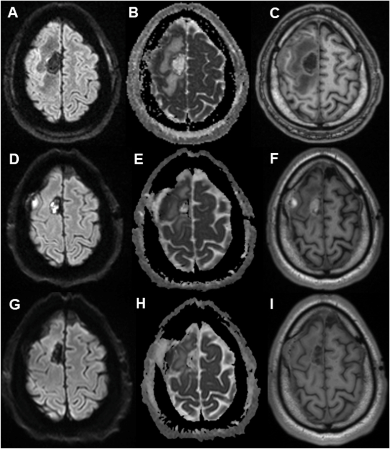 Matched DWI, ADC and T1 MRI sequences showing restricted diffusion in the abscess cavity. Include a caption explaining that DWI is supportive and must be interpreted with the clinical and microbiological context.
