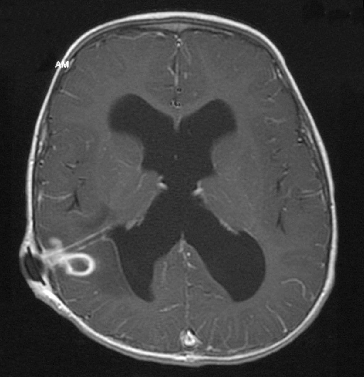 Axial post-contrast T1 MRI showing a small smooth ring-enhancing right parietal abscess with surrounding oedema. Label the modality and avoid implying that ring enhancement alone is diagnostic.