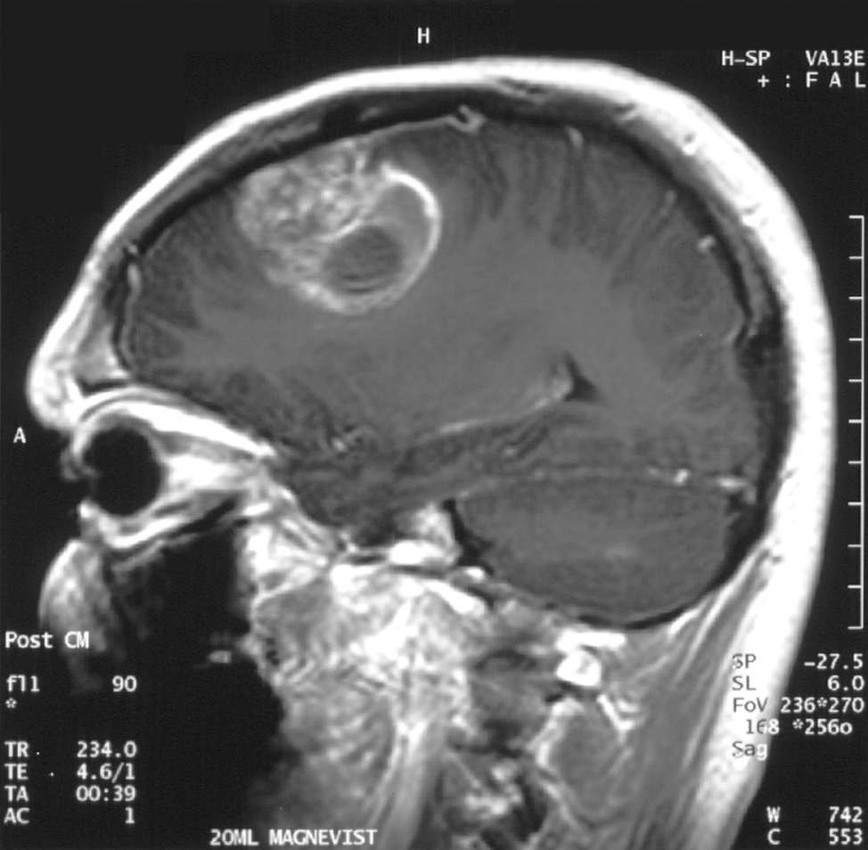 Sagittal post-contrast T1 MRI showing an irregular ring-enhancing frontal mass with central necrosis and surrounding oedema. Explain that this pattern needs differential diagnosis and tissue or specialist interpretation.