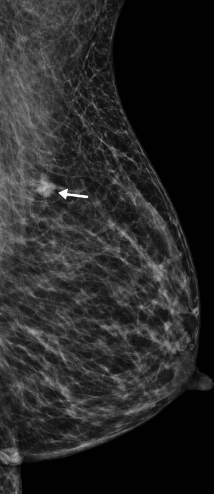Mammography showing an irregular spiculated mass, with labels explaining why a suspicious imaging finding proceeds to specialist triple assessment rather than being diagnosed from imaging alone.