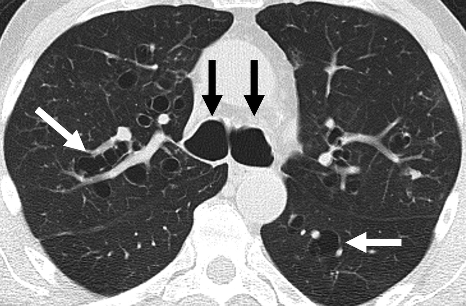 Axial high-resolution CT showing dilated thick-walled bronchi larger than adjacent pulmonary arteries, producing signet-ring and tram-track appearances highlighted by the arrows.