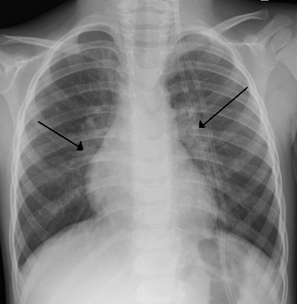 Chest radiograph showing hyperinflation and patchy atelectasis; imaging is not routinely required but is shown for teaching when intensive care or an alternative diagnosis is being considered.