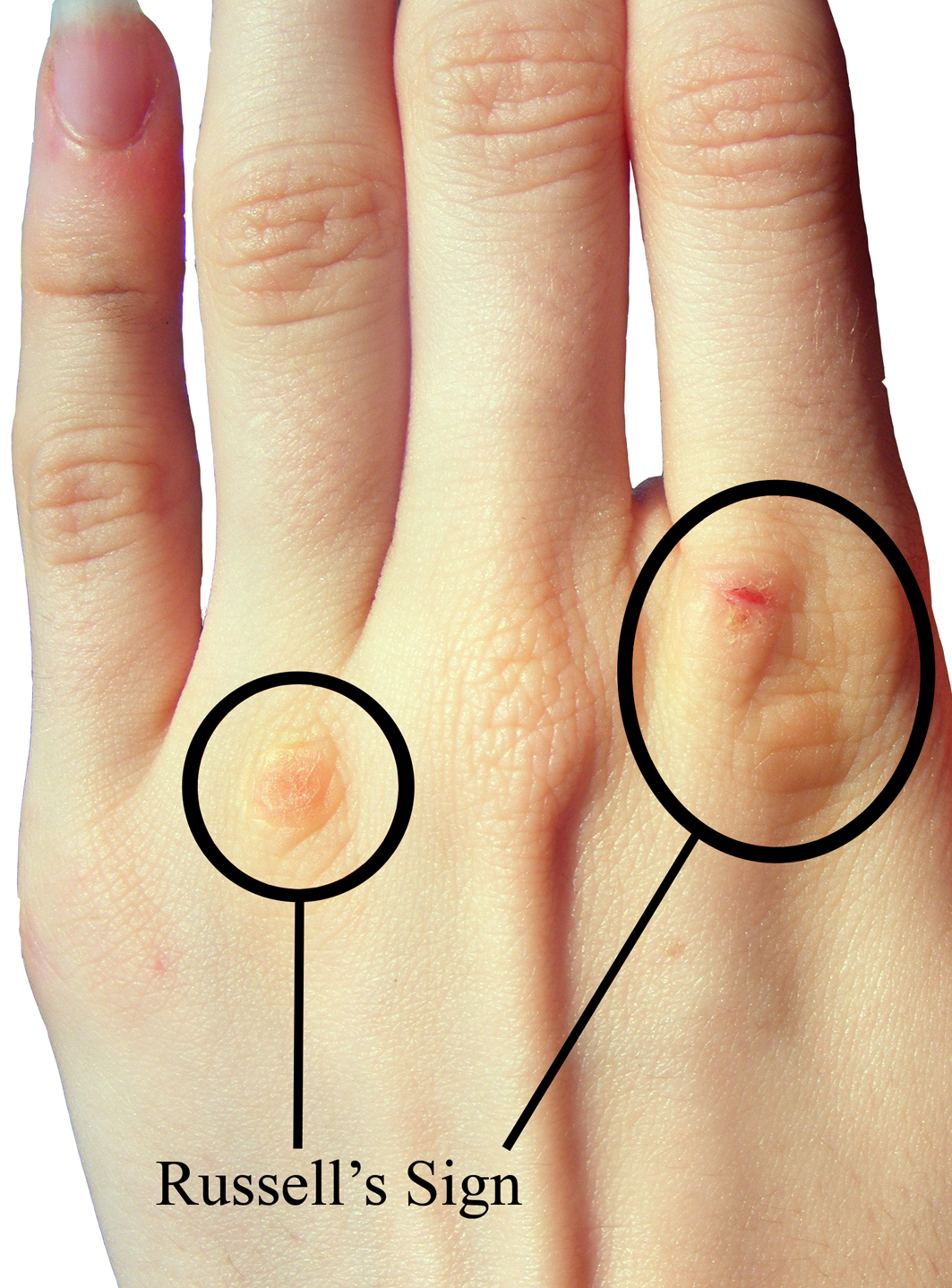 Clinical photograph showing callus and abrasion over the knuckles from repeated self-induced vomiting; it is a clue, not a required feature.