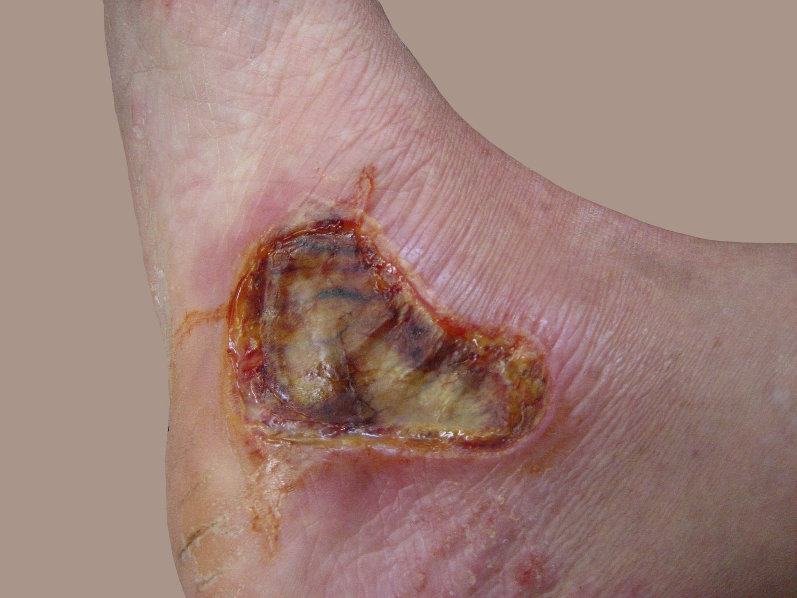 A clinical photograph of a full-thickness contact burn showing dry adherent eschar and loss of viable surface tissue; clinical images must be accompanied by depth and safety context.