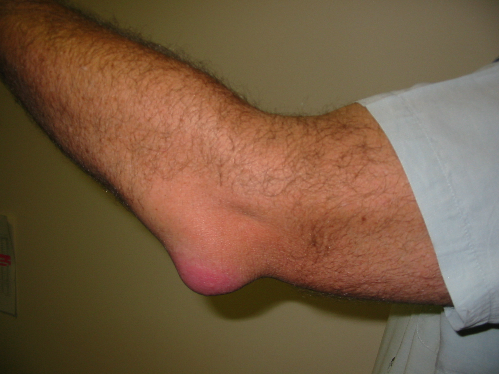 A clinical photograph of a fluctuant swelling over the point of the elbow, with a note that the photograph does not determine whether the bursa is sterile or infected and that the elbow joint must still be examined.