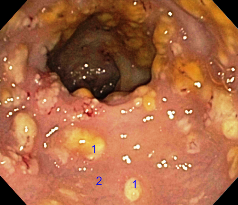 Colonic mucosa studded with yellow pseudomembranes in Clostridioides difficile pseudomembranous colitis (pathological specimen).