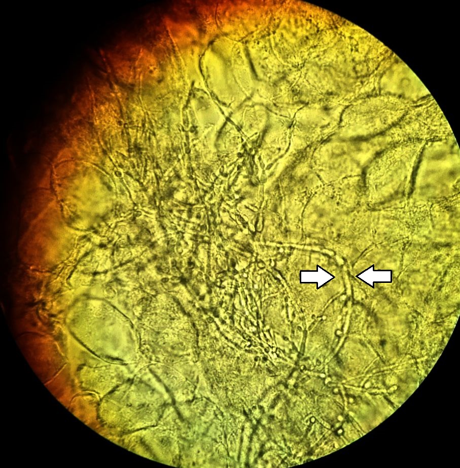 Vaginal wet mount showing branching Candida pseudohyphae and yeast forms, with arrows marking representative filaments.