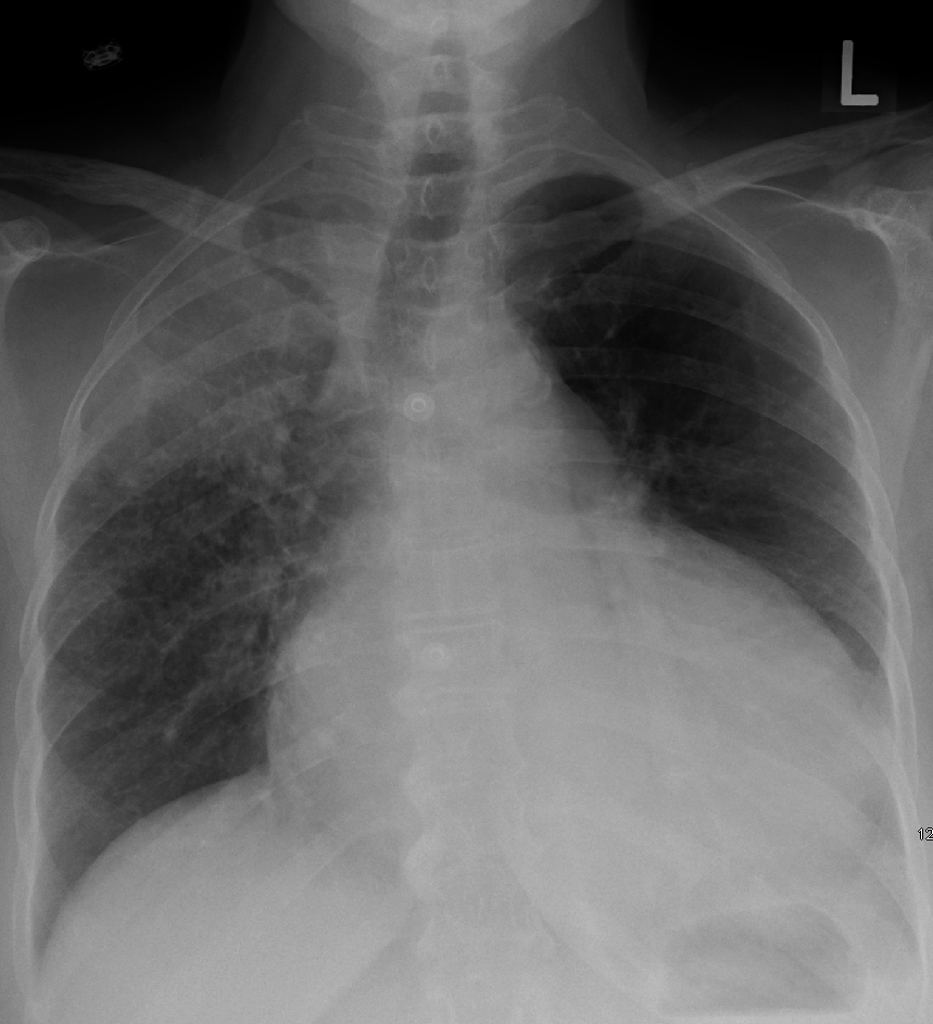 Frontal chest radiograph showing a smooth enlarged cardiac silhouette from a large effusion, with a caption warning that acute tamponade can have a normal-sized silhouette.