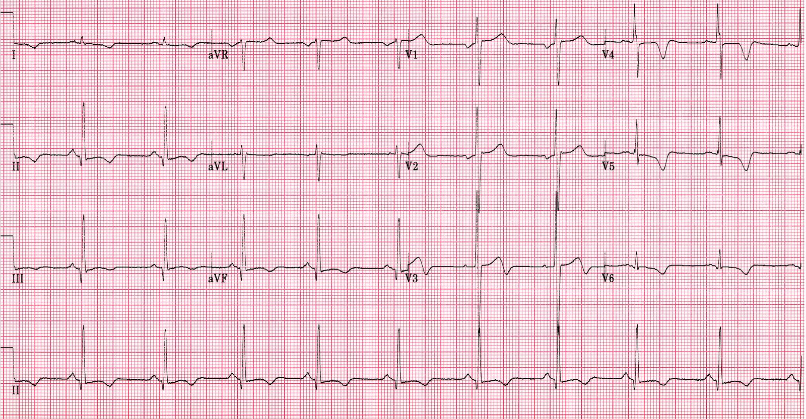 Twelve-lead ECG from hypertrophic cardiomyopathy showing high precordial voltages and prominent repolarisation abnormalities, with a reminder that ECG findings support but do not establish the phenotype alone.