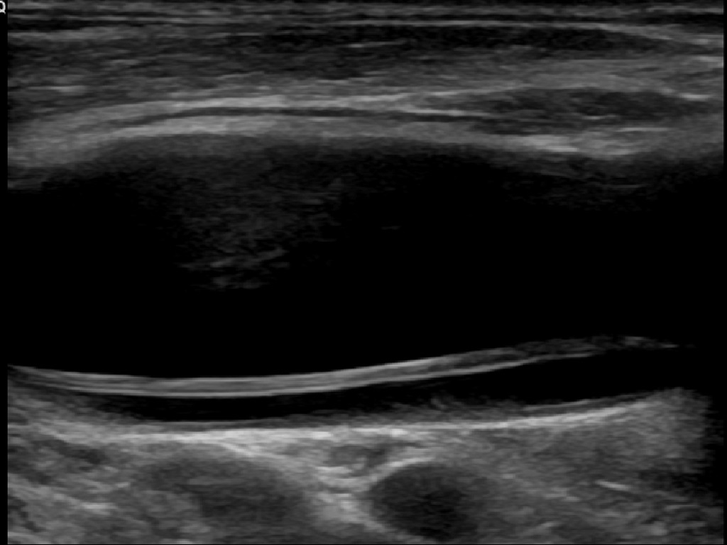 Longitudinal carotid ultrasound showing an echogenic intimal flap separating true and false lumens, with a note that a normal ultrasound does not exclude a high cervical dissection.