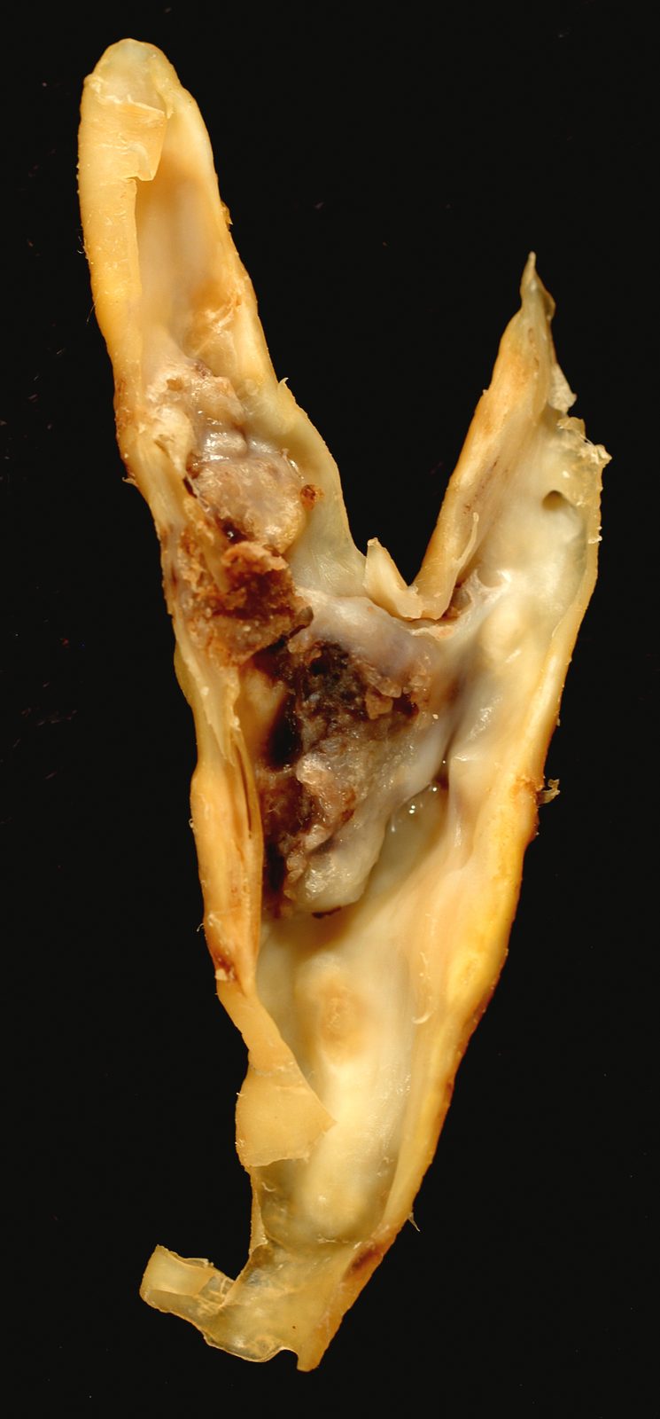 Excised carotid-bifurcation specimen opened to show bulky yellow-white atherosclerotic plaque and haemorrhagic material removed during endarterectomy.