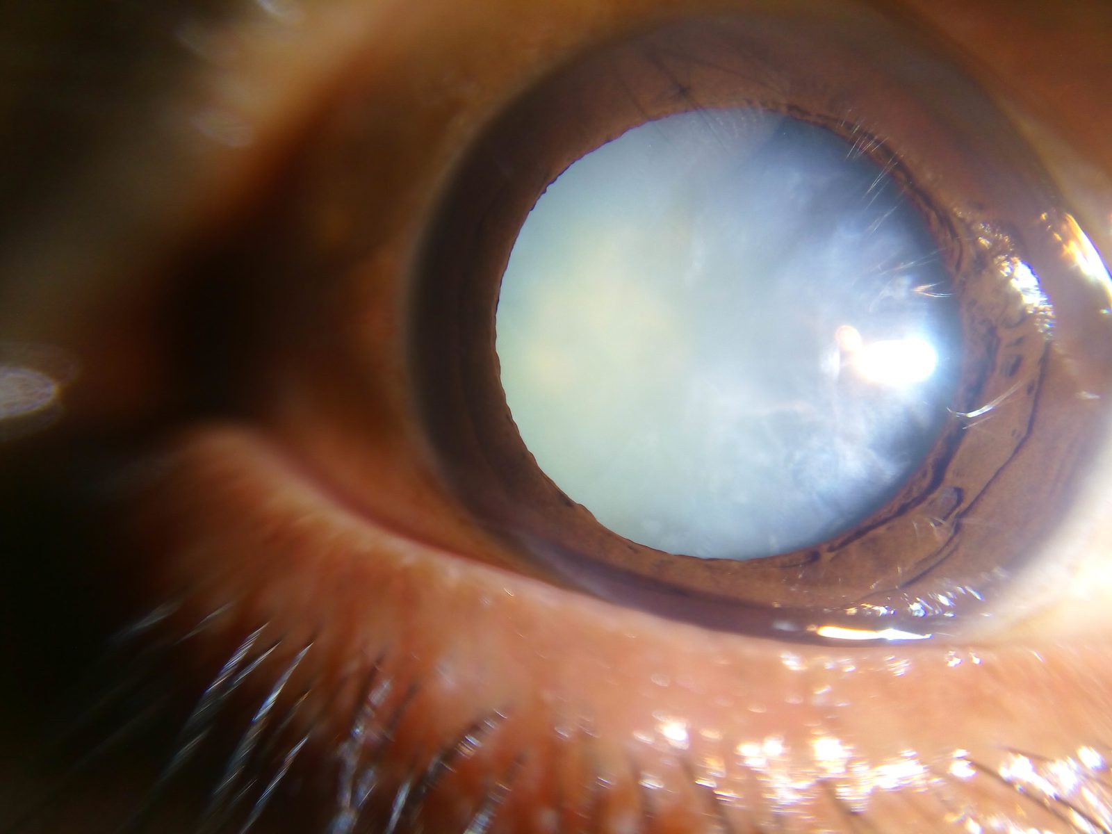 Close clinical photograph showing the dense white lens opacity of a mature cataract filling the pupillary area.