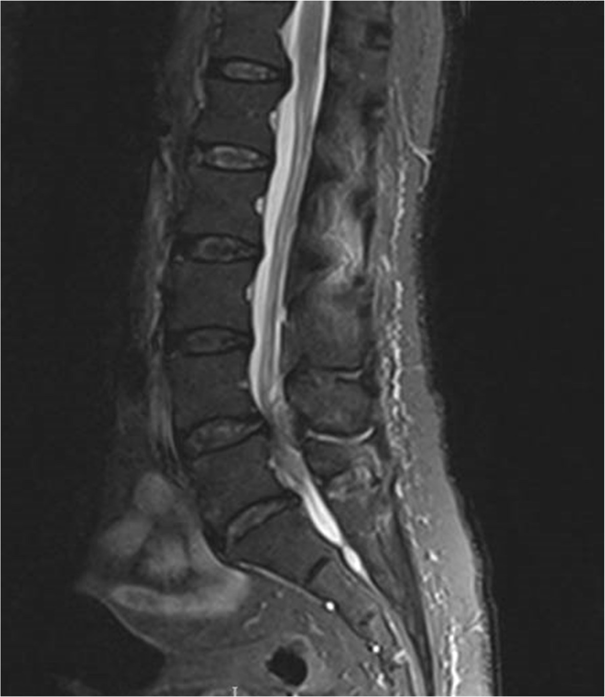 Sagittal T2-weighted lumbar MRI showing a posterior epidural collection that severely compresses the thecal sac and cauda equina.