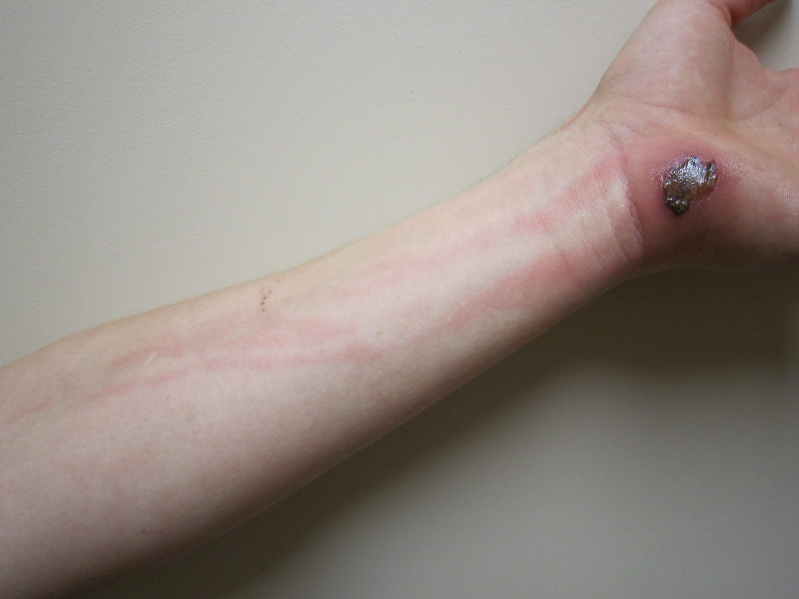 Clinical photograph showing erythema around a hand abrasion with a linear red streak extending proximally along the forearm, indicating lymphangitic spread of cellulitis.