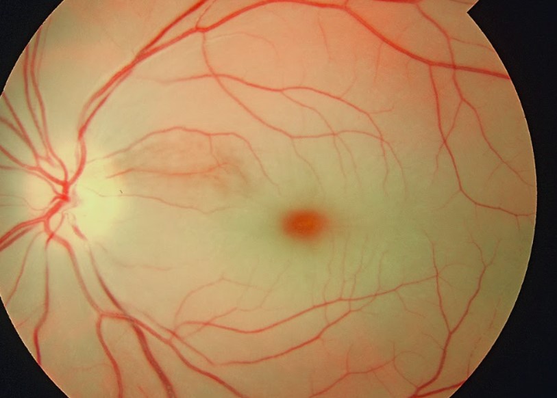 A fundus image showing diffuse pale retinal whitening from inner-retinal ischaemia with a cherry-red spot at the fovea. Label it as an illustrative clinical image, not a substitute for urgent examination.