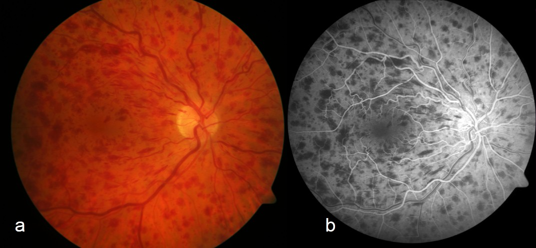 A two-panel retinal study showing widespread four-quadrant retinal haemorrhages and dilated tortuous veins on colour fundus photography, alongside specialist angiographic assessment. Label it as an illustrative image, not a substitute for clinical examination.
