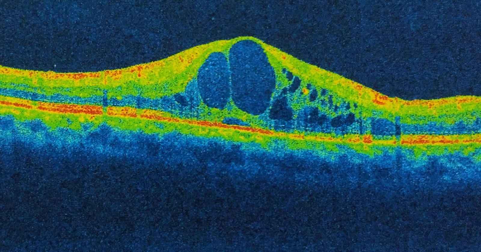 Macular OCT showing increased central retinal thickness with intraretinal cystoid fluid spaces, illustrating a structural cause of central vision loss in retinal vein occlusion.