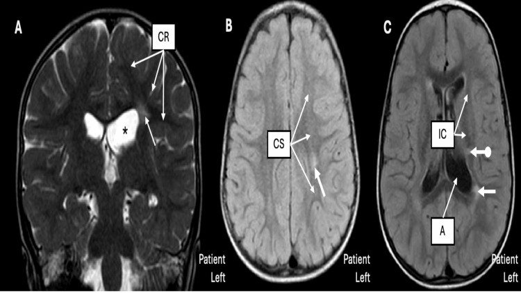 Coronal and axial brain MRI panels demonstrating periventricular white-matter injury; retain the source attribution and licence while image-quality remediation remains in the separate image campaign.