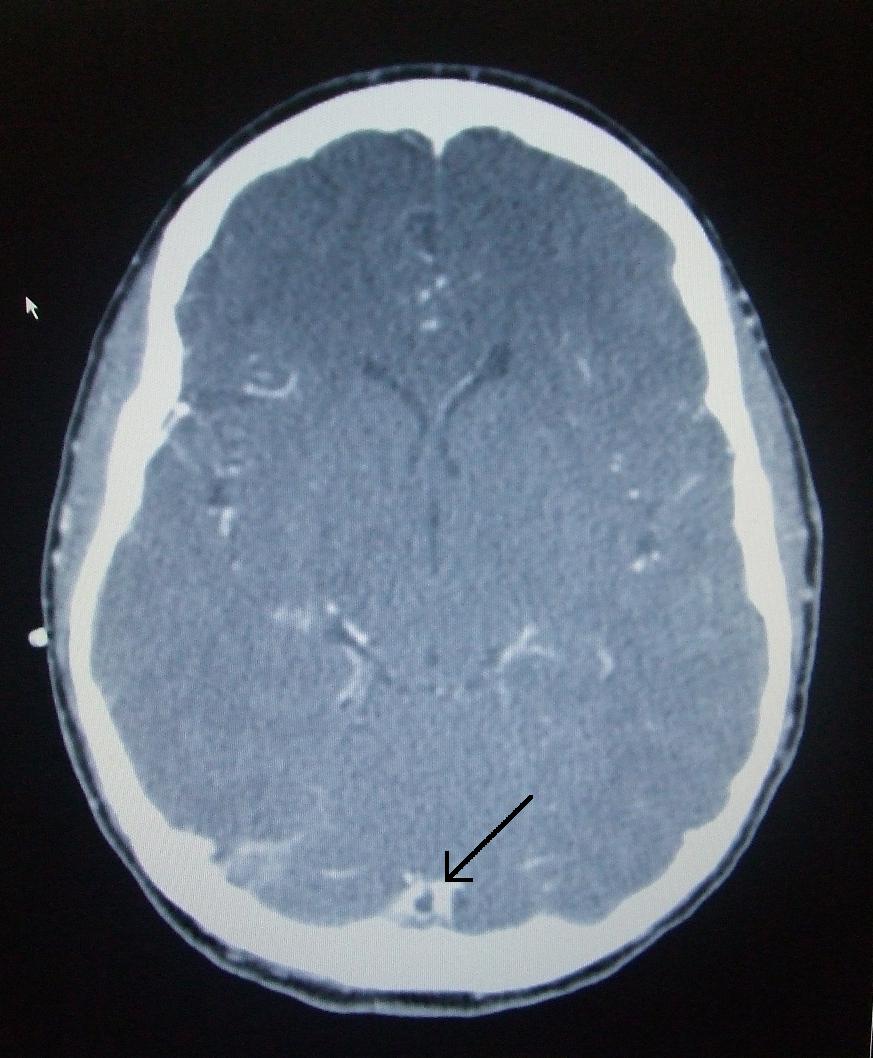 Contrast-enhanced axial CT showing a triangular central filling defect in the superior sagittal sinus, the empty delta sign of cerebral venous sinus thrombosis.