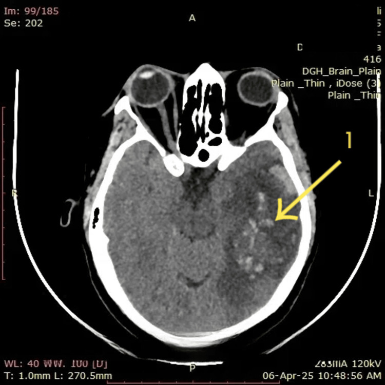 Axial non-contrast CT showing an arrowed left temporal haemorrhagic focus with extensive surrounding hypodense oedema, consistent with haemorrhagic venous infarction in cerebral venous sinus thrombosis.
