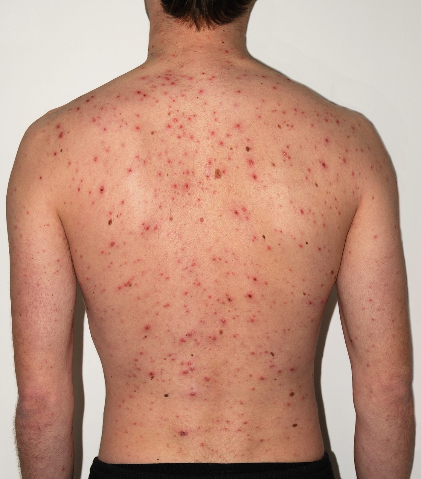 Clinical photograph of the back showing the typical centripetal chickenpox eruption with papules, vesicles, pustules and crusted lesions present simultaneously.