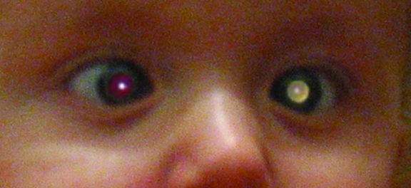 A sourced clinical photograph showing a white pupillary reflex; retain attribution and licence and keep image-quality remediation in the separate image campaign.