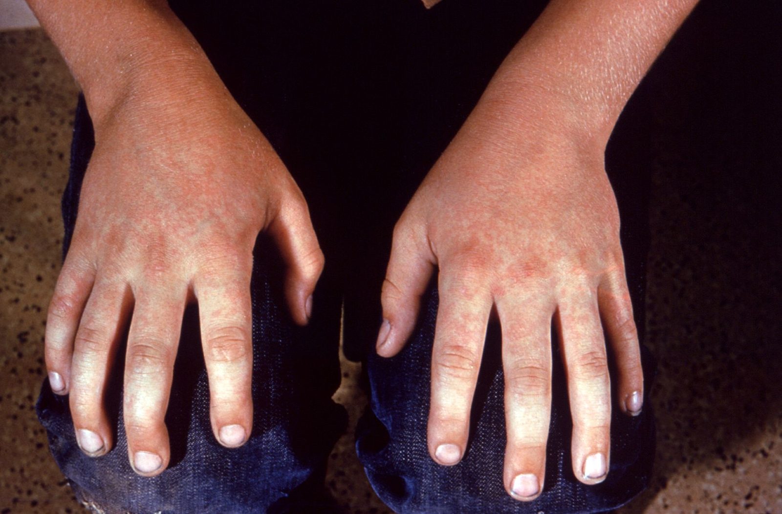 Clinical photograph showing a symmetrical erythematous eruption over the hands and distal forearms in fifth disease (erythema infectiosum).