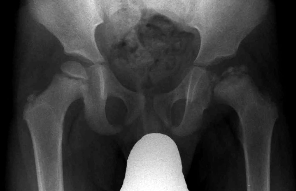 AP pelvic radiograph showing unilateral sclerosis, fragmentation and flattening of the capital femoral epiphysis in Legg-Calvé-Perthes disease; retain source attribution while image-quality remediation remains separate.