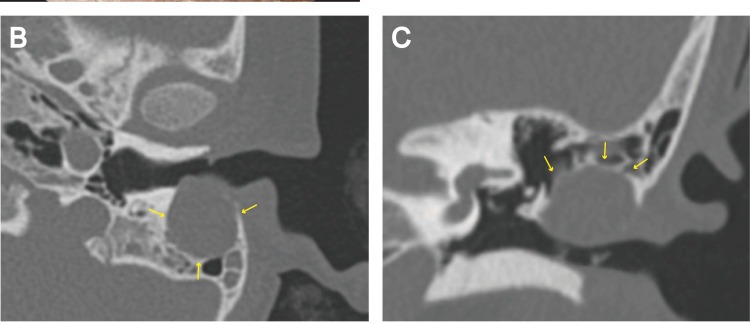 Axial and coronal temporal-bone CT images showing a cholesteatoma as a well-defined external auditory canal mass with erosion of the posterior bony canal wall, marked by arrows.