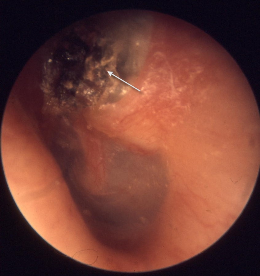 An otoscopic photograph showing an attic retraction pocket filled with white keratin debris in the posterosuperior tympanic membrane, the characteristic appearance of cholesteatoma.