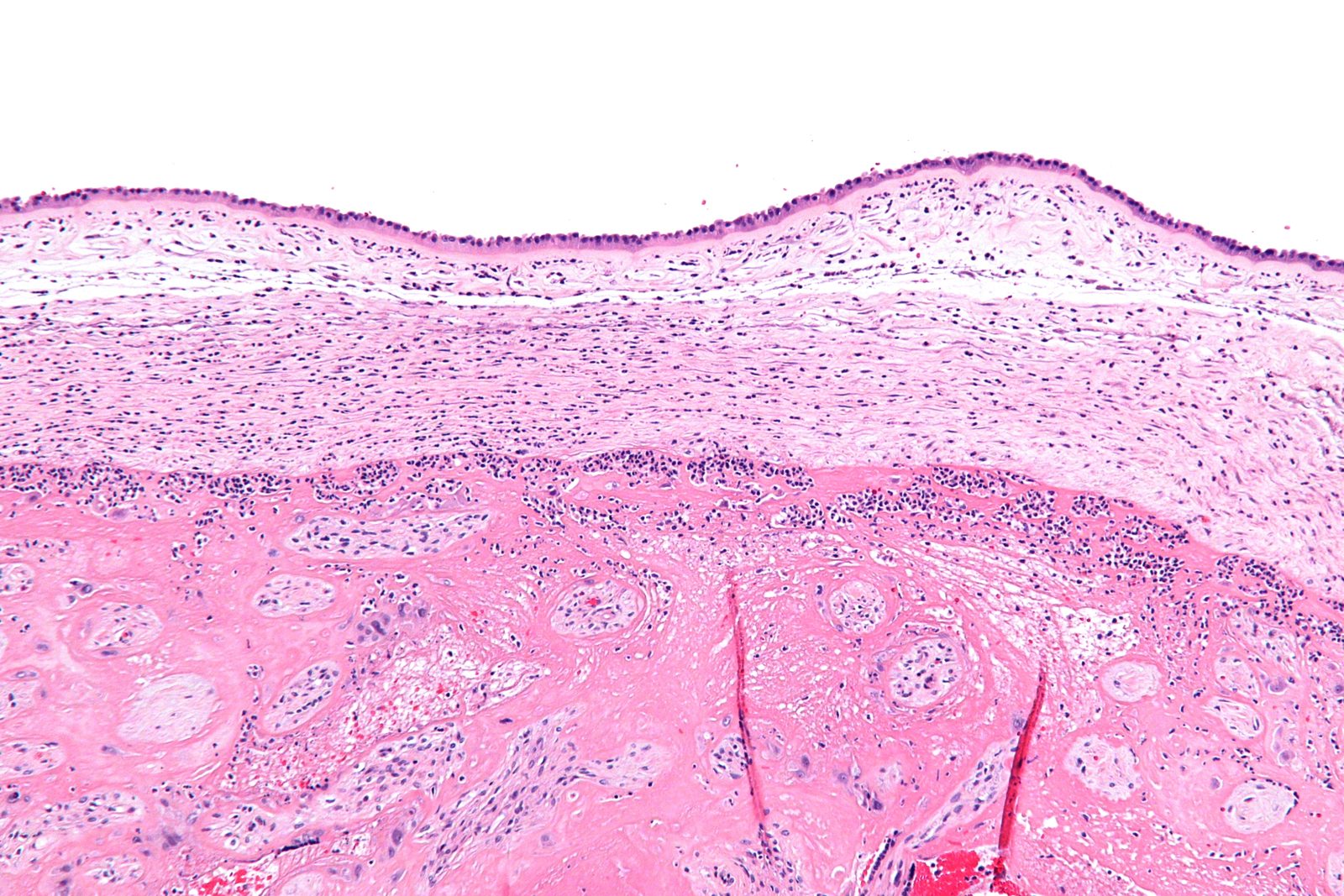 H&E histology of fetal membranes showing acute neutrophilic inflammation of the chorion and amnion, the pathological correlate of ascending intra-amniotic infection.