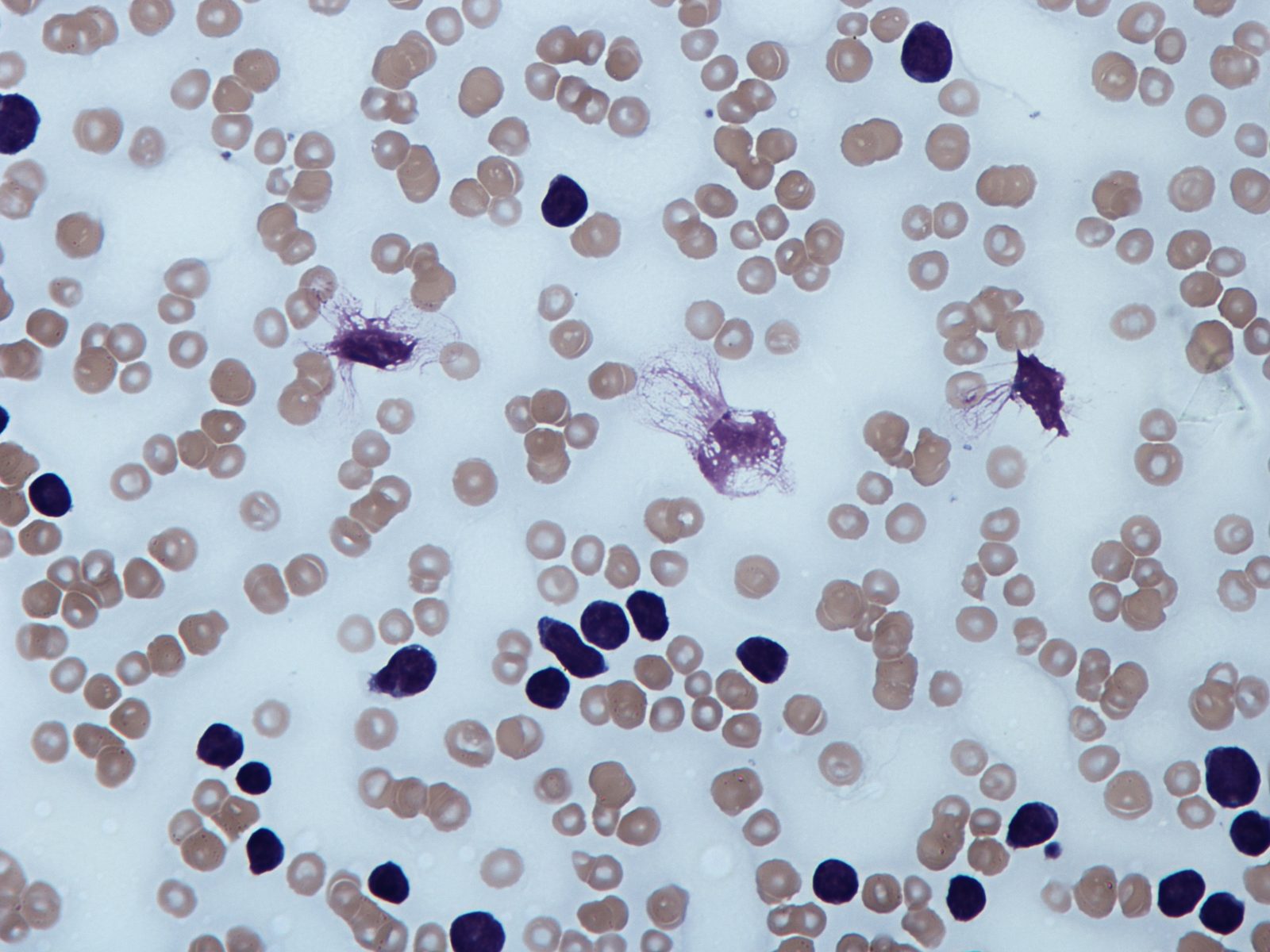Peripheral blood film showing small mature lymphocytes and characteristic smudge (smear) cells.