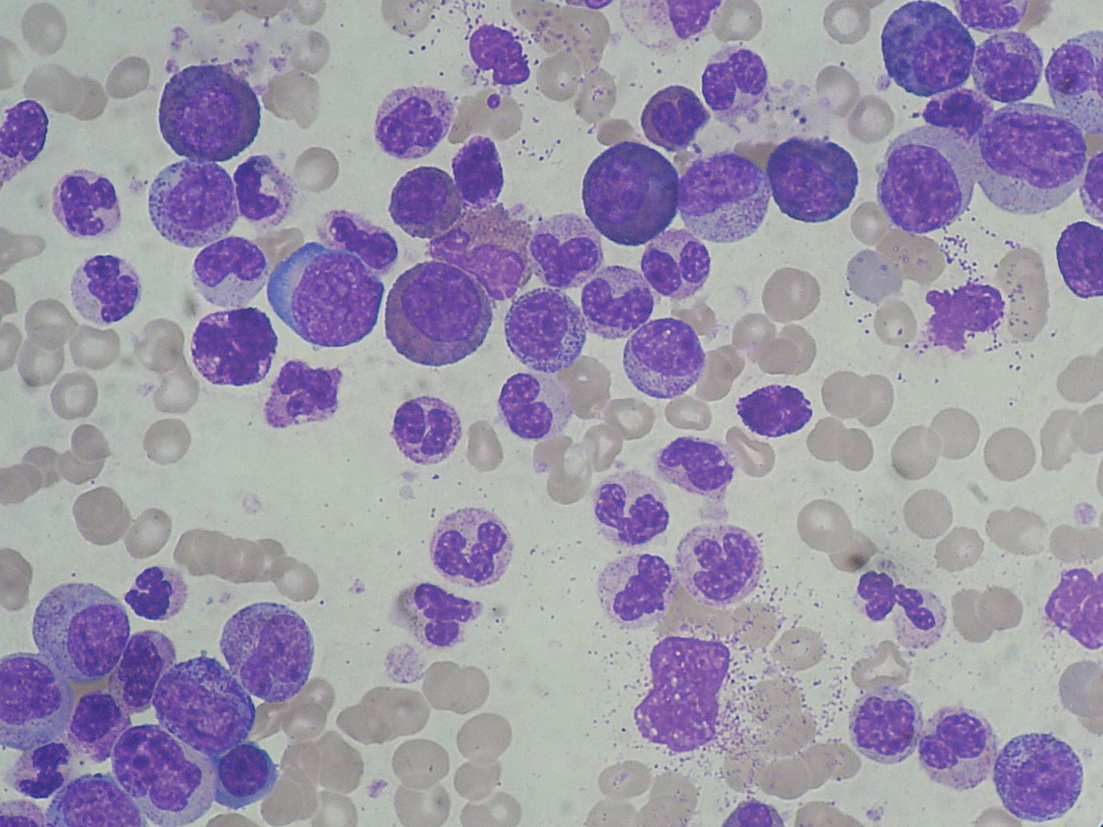Peripheral blood film showing marked leucocytosis with the full maturing granulocyte series and basophilia, without a blast excess.