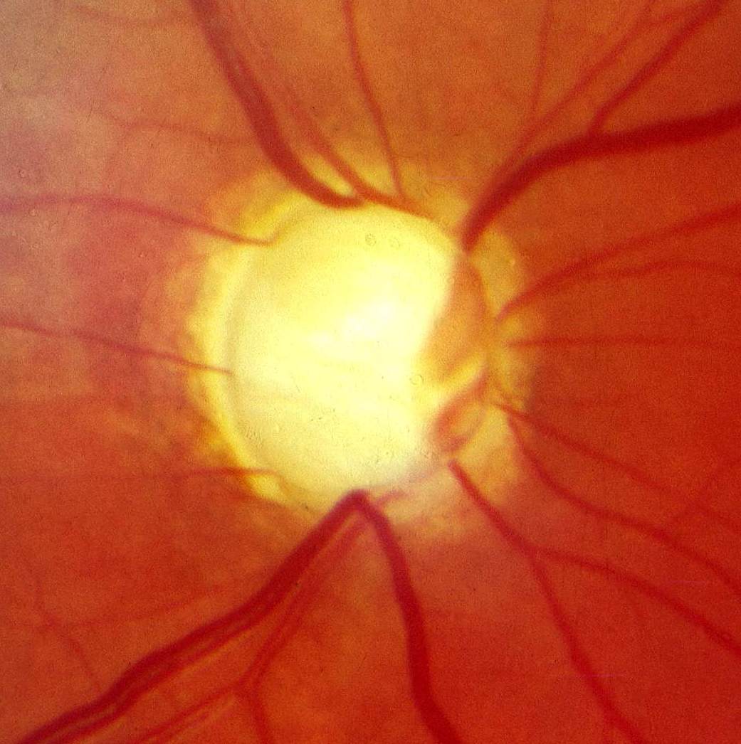 Colour fundus photograph showing advanced glaucomatous cupping with a large cup-to-disc ratio, marked neuroretinal-rim thinning and vessel displacement. Label it as an illustrative image; disc appearance must be interpreted with fields, OCT and pressure.