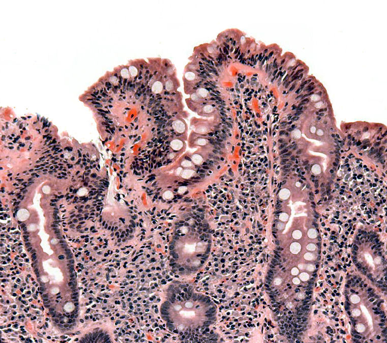 Duodenal biopsy histology showing villous blunting, crypt hyperplasia and inflammatory cells associated with coeliac disease.