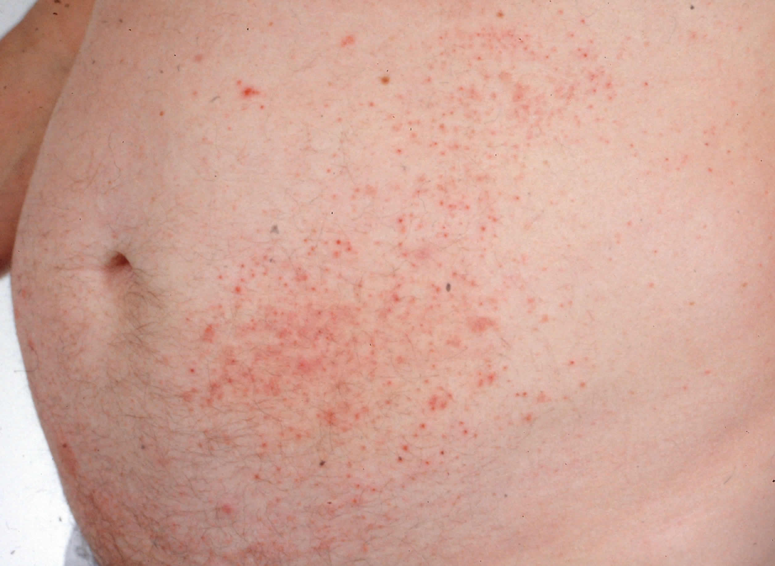 Clinical photograph of the symmetrical, intensely itchy vesicular rash associated with coeliac disease.