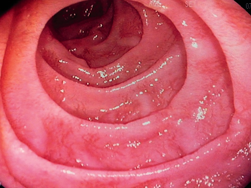 Endoscopic view of the second part of the duodenum showing scalloped or fissured folds that may suggest villous injury.