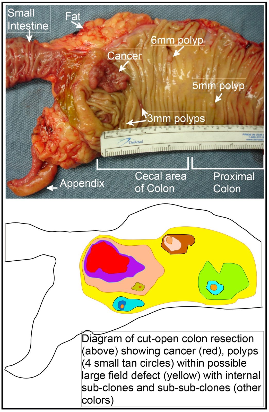 Gross surgical specimen showing a colorectal carcinoma with adjacent polyps, illustrating that synchronous precursor lesions may coexist with an established cancer.