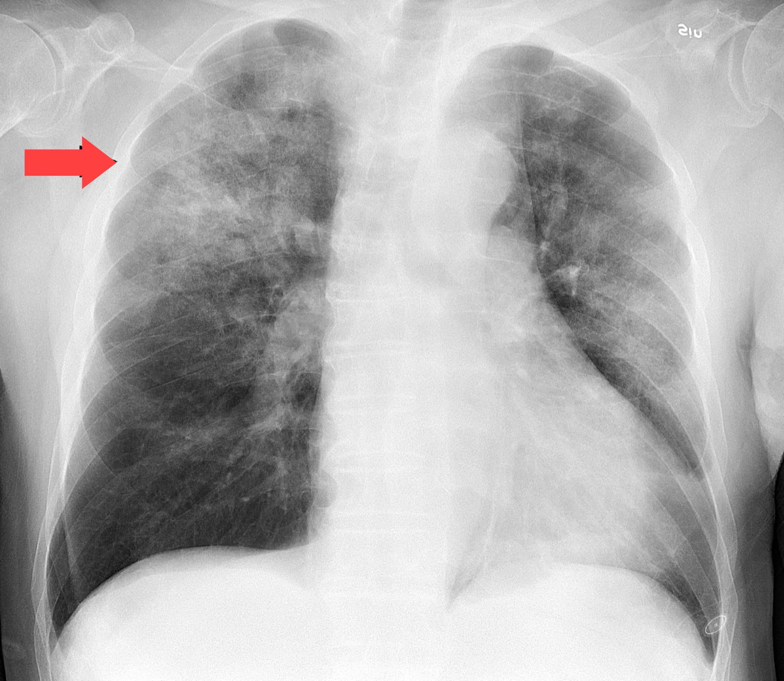Annotated frontal chest radiograph showing dense right upper-lobe air-space consolidation in community-acquired pneumonia.