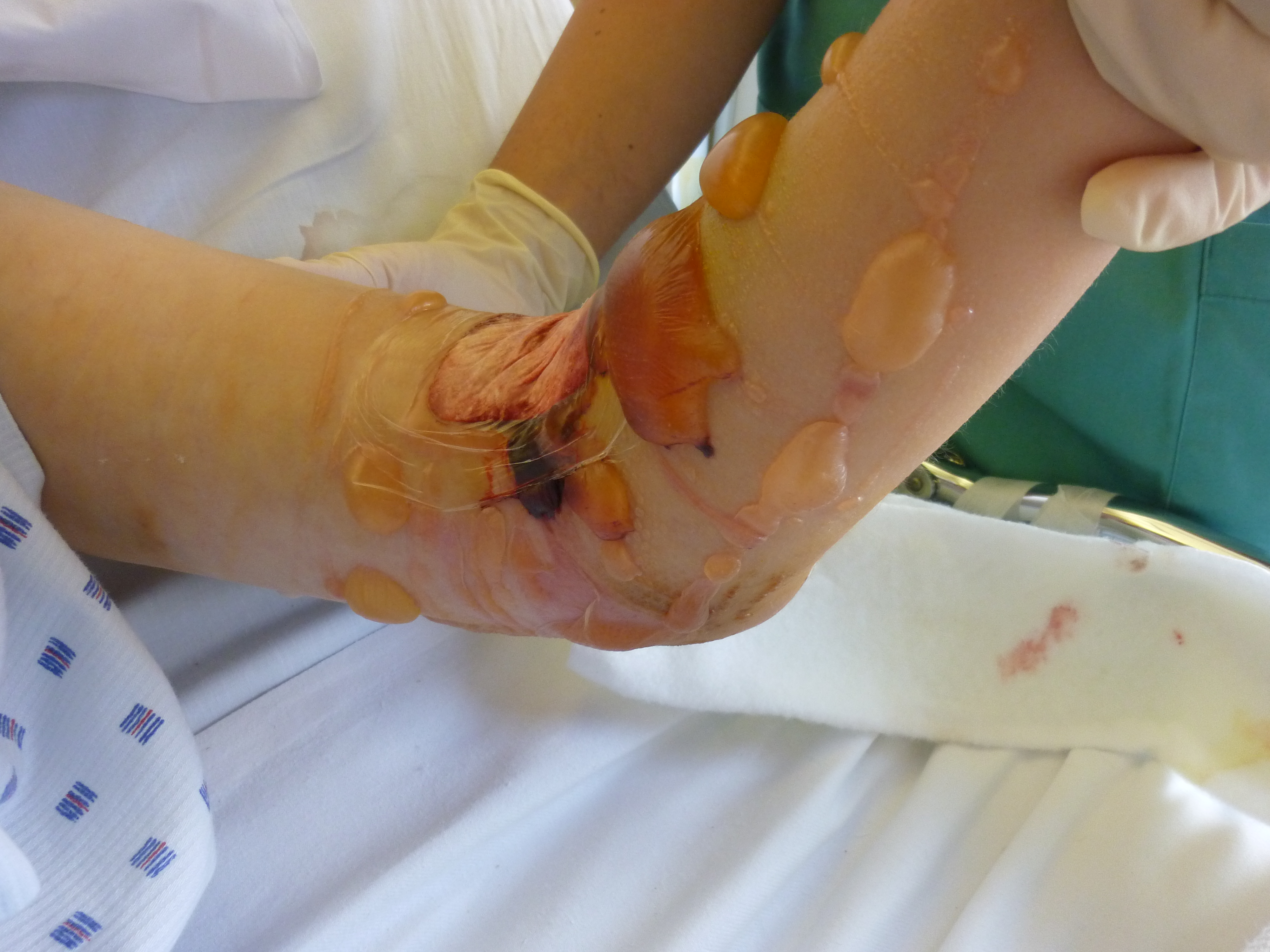 Photograph illustrating a tensely swollen, shiny lower leg following tibial fracture, before fasciotomy.