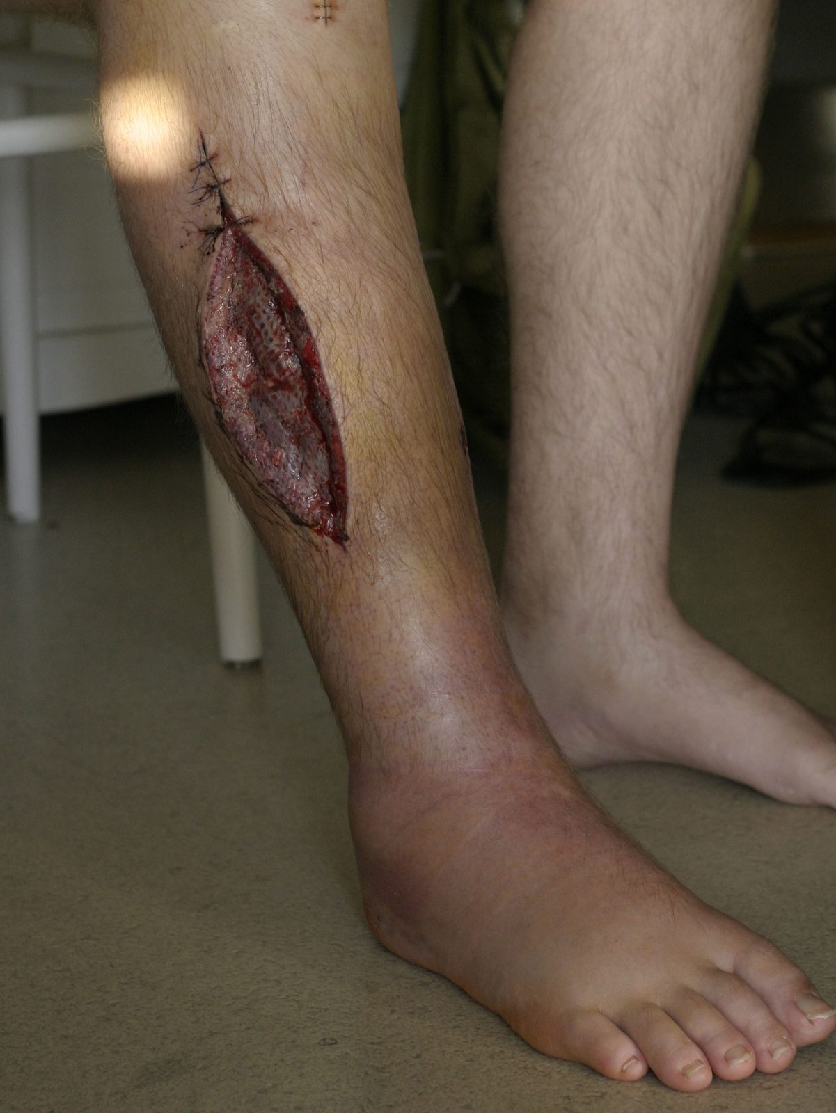 Clinical photograph of a long lower-leg fasciotomy wound following surgical compartment decompression, illustrating why staged re-exploration and definitive soft-tissue management are required.