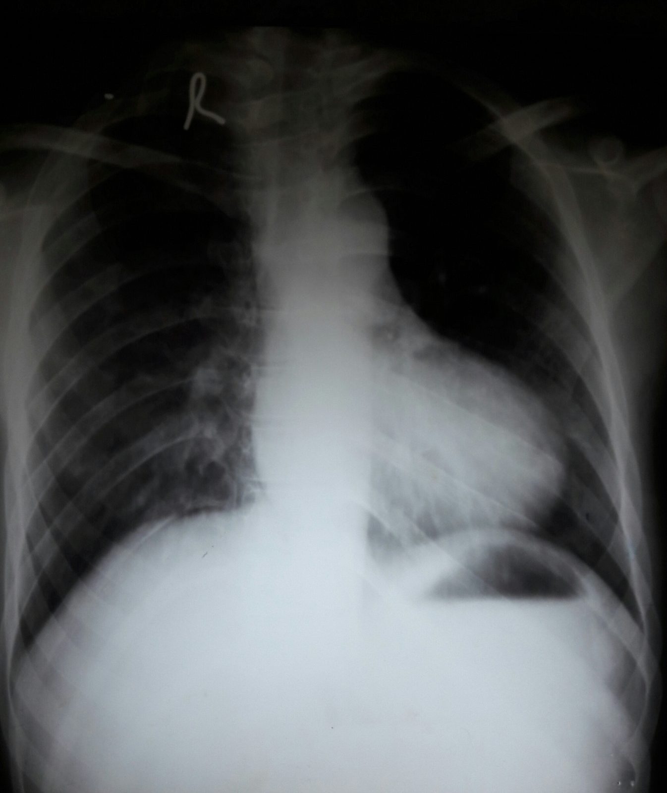 Chest radiograph showing the classic boot-shaped cardiac silhouette of tetralogy of Fallot, with a note that radiography supports but does not replace echocardiographic diagnosis.