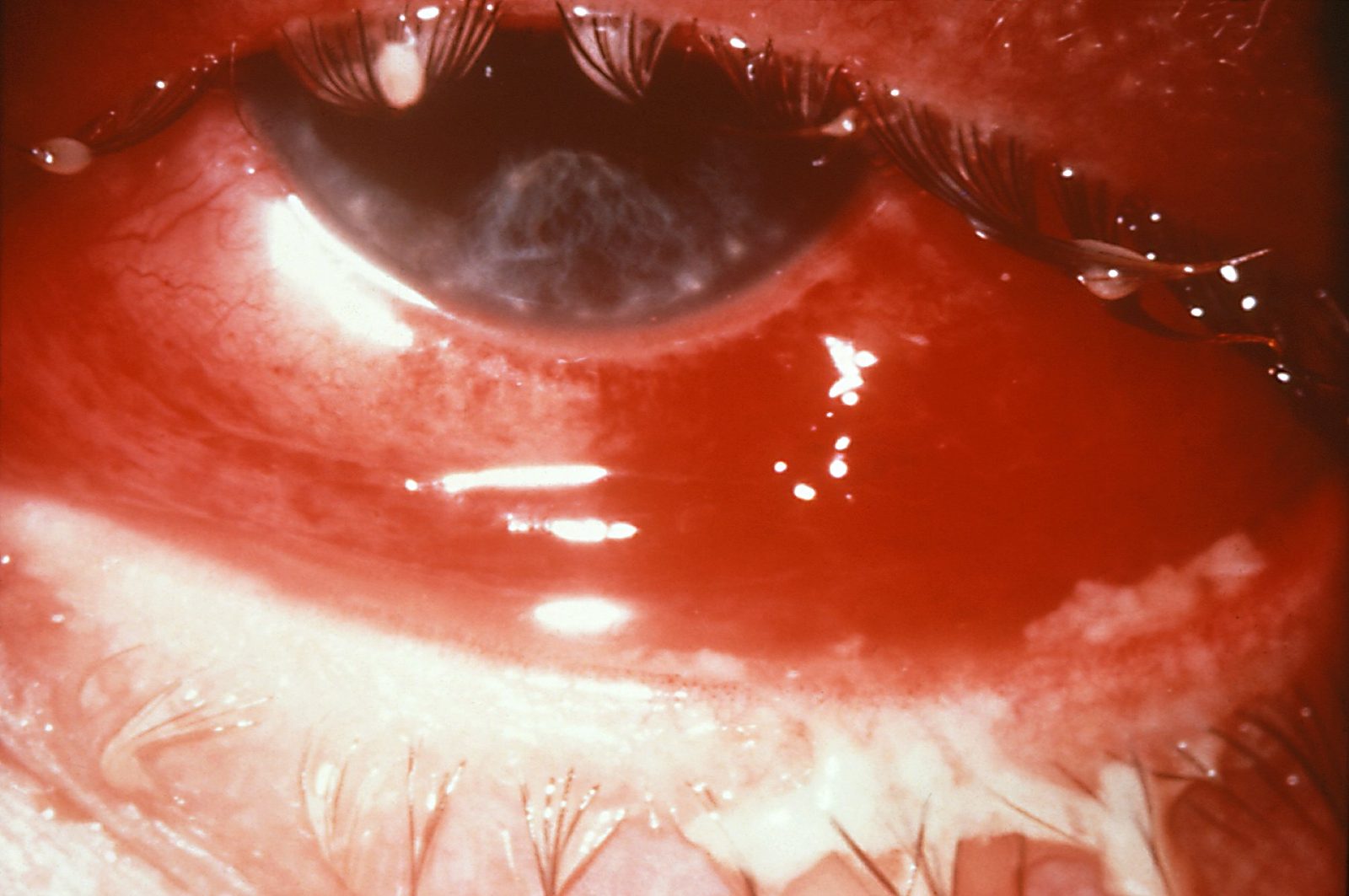Clinical photograph of a red eye with thick purulent discharge and crusted lashes; discharge supports but does not by itself prove the bacterial cause.