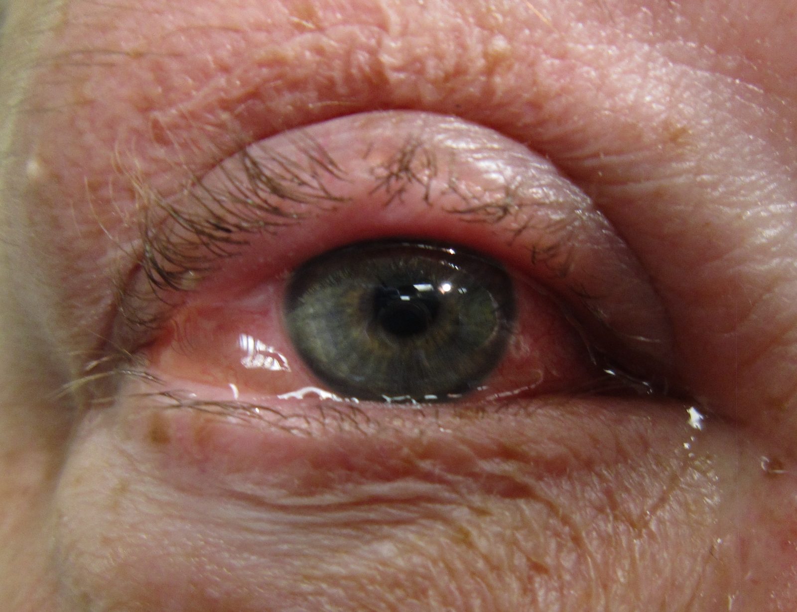 Clinical photograph showing bilateral watery, itchy eyes with conjunctival swelling or chemosis.