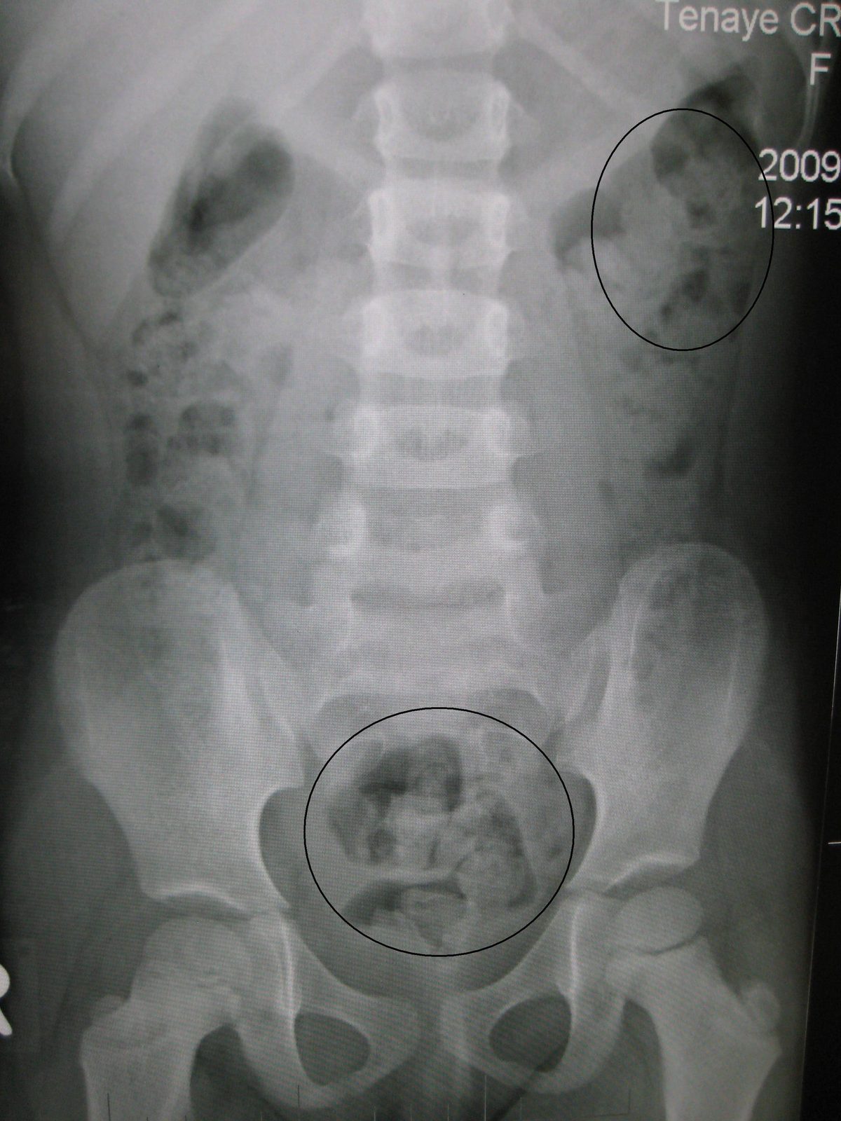 A radiograph illustrating faecal loading, labelled as a selected specialist investigation rather than a routine diagnostic test for uncomplicated constipation.