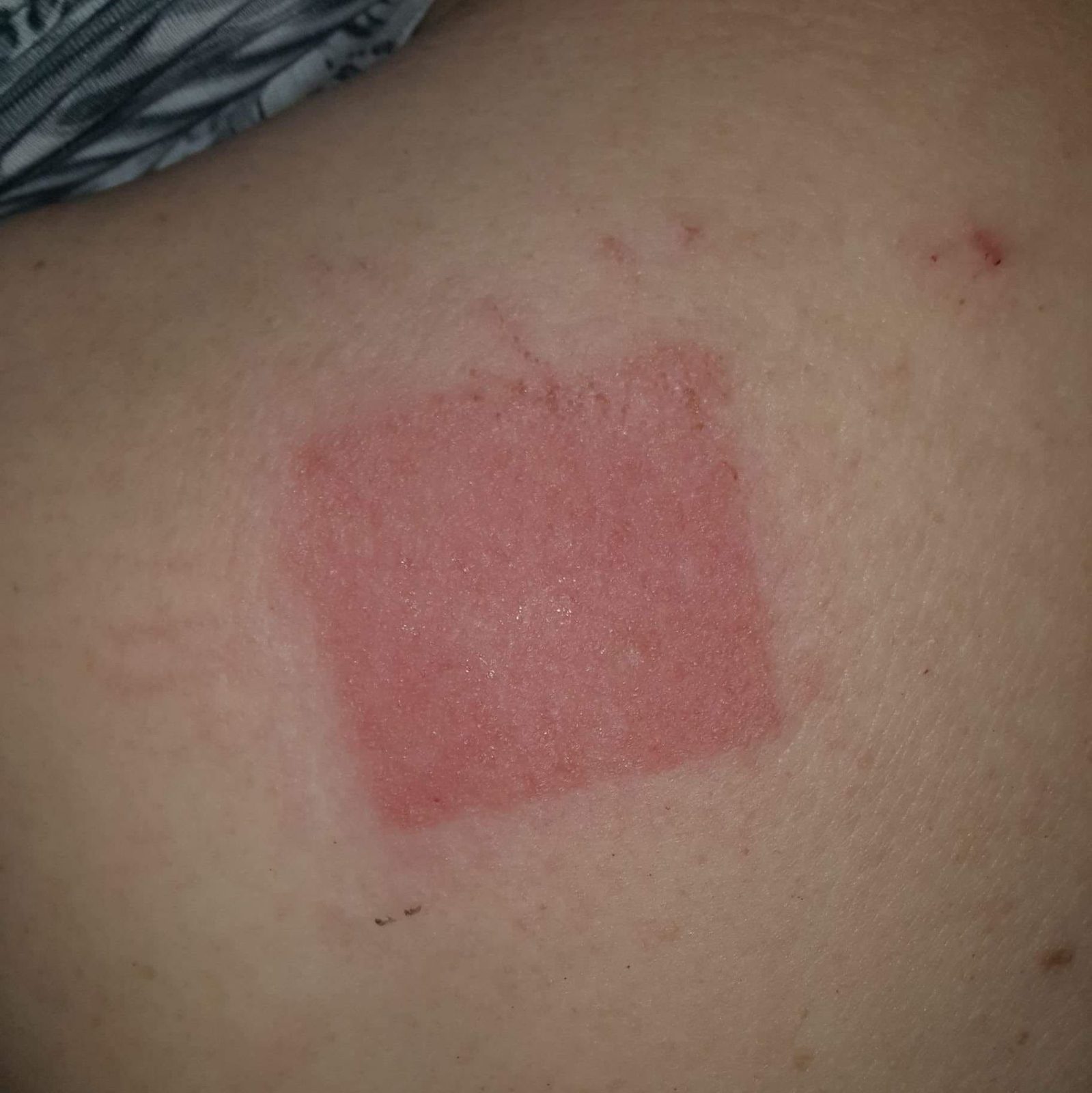 A clinical photograph of sharply demarcated eczema at a jewellery or jean-stud contact site, illustrating a contact pattern rather than a generalised eczema distribution.